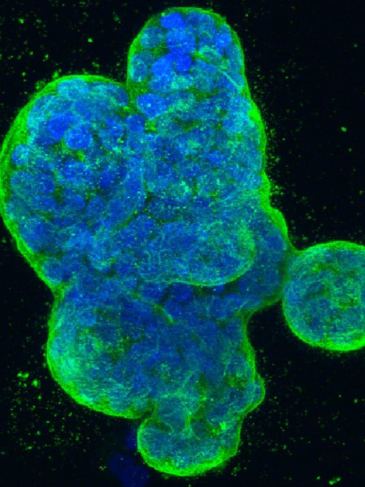 En 3D-bild av bröstcancer fångad av amerikanska National Institutes of Health, med DNA i blå färg och proteiner i cellmembranet färgad grön.